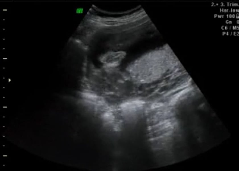 Ambiguous Genitalia Ultrasoundpaedia 9546