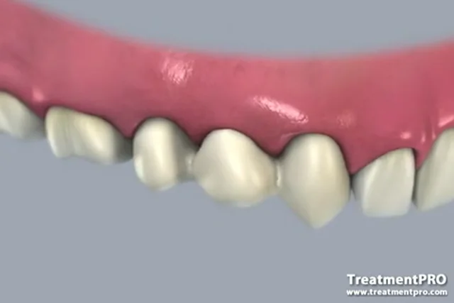 Dental Bridge Treatment