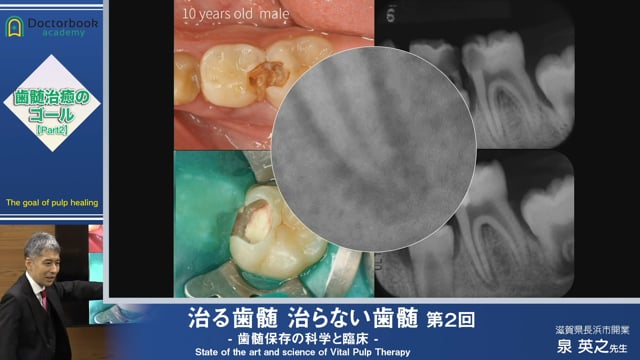 #2 う蝕により露髄した歯髄の治癒