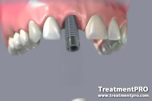 Dental Implants