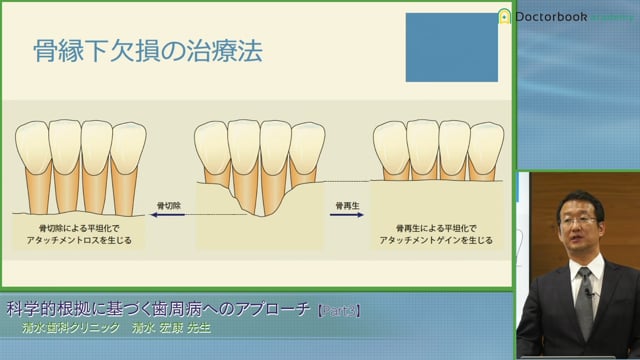 #3 歯周組織再生に影響を与える因子・歯レベル