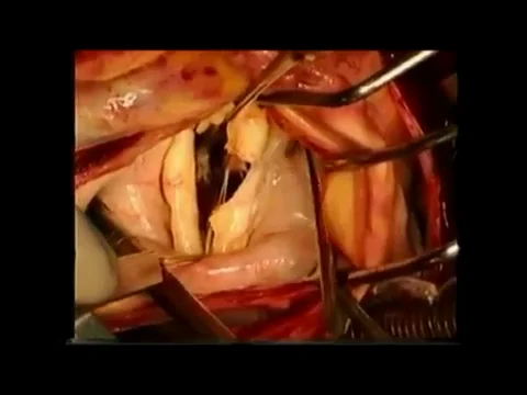 M Open mitral commissurotomy