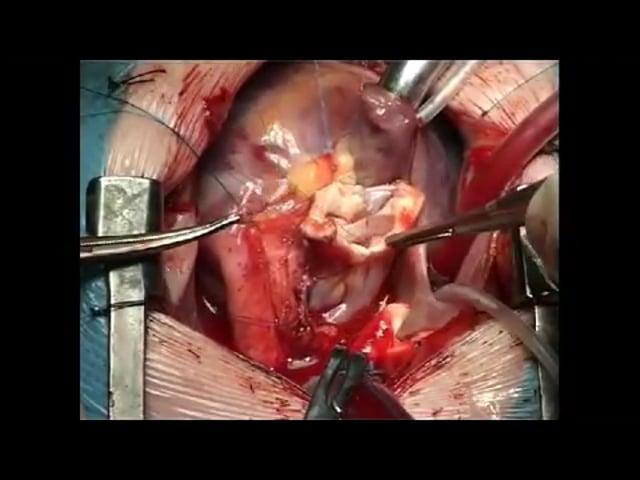 aortic ring surgery