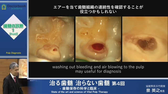 治る歯髄 治らない歯髄 - 歯髄保存の科学と臨床 - 第４回 「歯髄の診断 