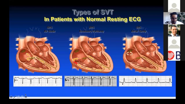 HeadStart 2020: Supraventricular Tachycardia