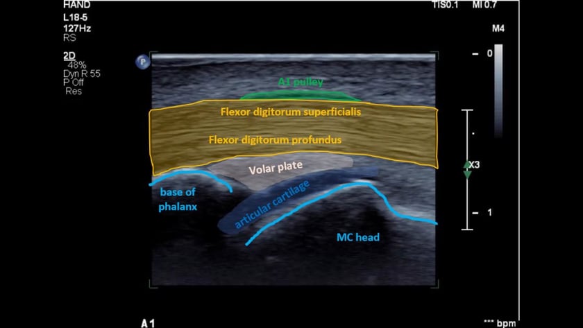 Hand Finger Normal Ultrasoundpaedia 0079