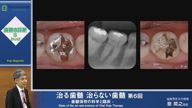 治る歯髄 治らない歯髄 - 歯髄保存の科学と臨床 - 第６回 「歯髄の診断 