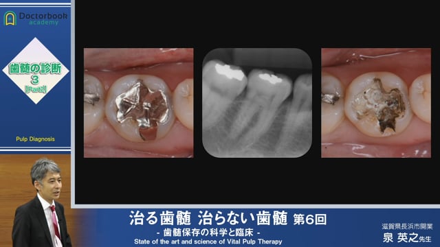 治る歯髄 治らない歯髄 - 歯髄保存の科学と臨床 - 第６回 「歯髄の診断 