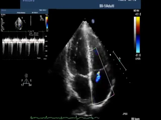Transthoracic Echocardiographic Images Obtained after Cardiac  Catheterization 