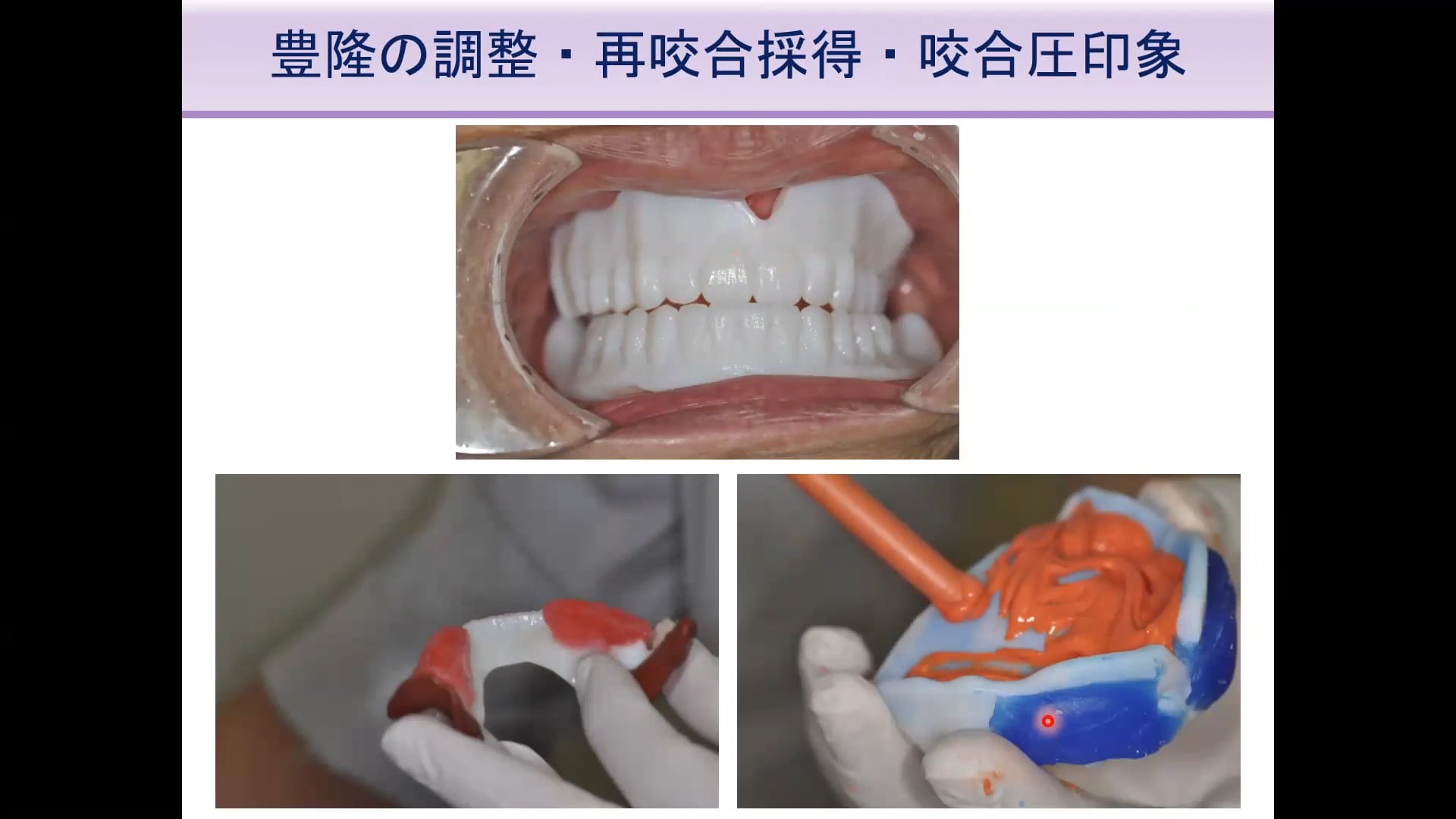 #1 Denture Cafe 第10回「世界のデジタルデンチャー最前線！」〜第二部：印象・咬合採得・試適はどうするべきか〜