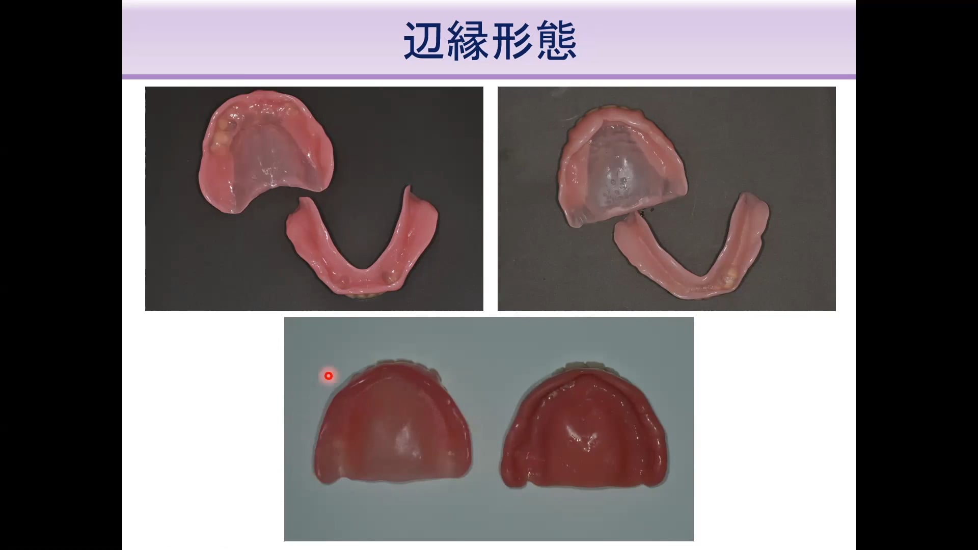 #3 Denture Cafe 第10回「世界のデジタルデンチャー最前線！」〜第二部：印象・咬合採得・試適はどうするべきか〜