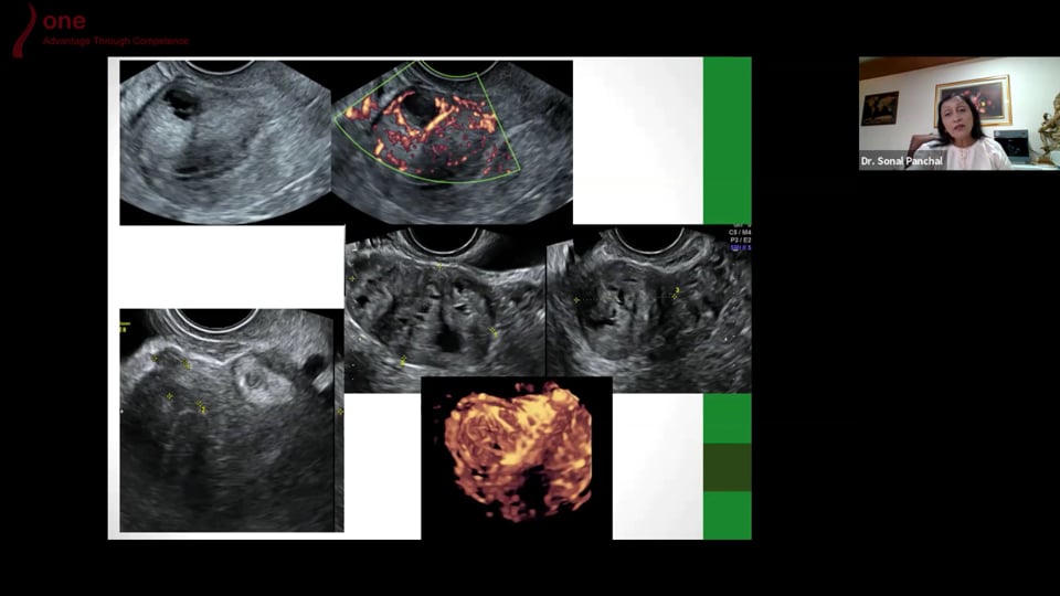 3D Uterus Fibroid and Polyps