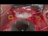 Gortex IOL Suturing 12-9-20