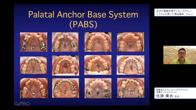 正中口蓋縫合部アンカースクリューシステムを用いた矯正臨床