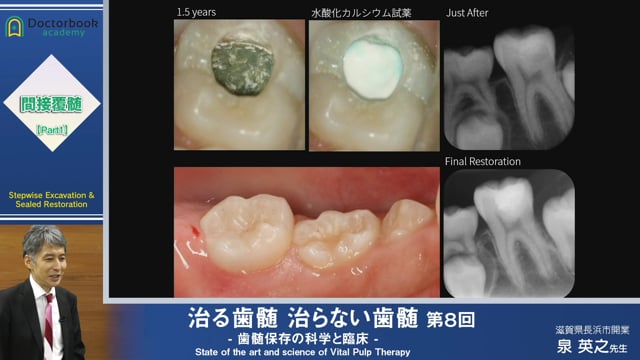 治る歯髄 治らない歯髄 - 歯髄保存の科学と臨床 - 第８回 「間接覆髄 