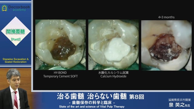 治る歯髄 治らない歯髄 - 歯髄保存の科学と臨床 - 第８回 「間接覆髄 