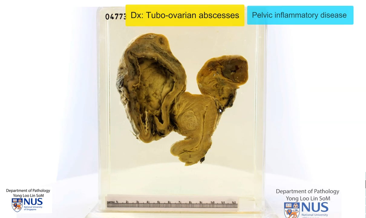 Uterus with adnexae: Tubo-ovarian abscesses