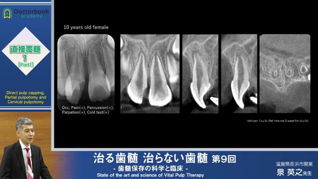 治る歯髄 治らない歯髄 - 歯髄保存の科学と臨床 - 第９回 「直接覆髄１ 