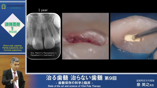 治る歯髄 治らない歯髄 - 歯髄保存の科学と臨床 - 第９回 「直接覆髄１ 