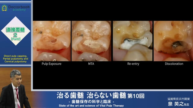 治る歯髄 治らない歯髄 - 歯髄保存の科学と臨床 - | Doctorbook 