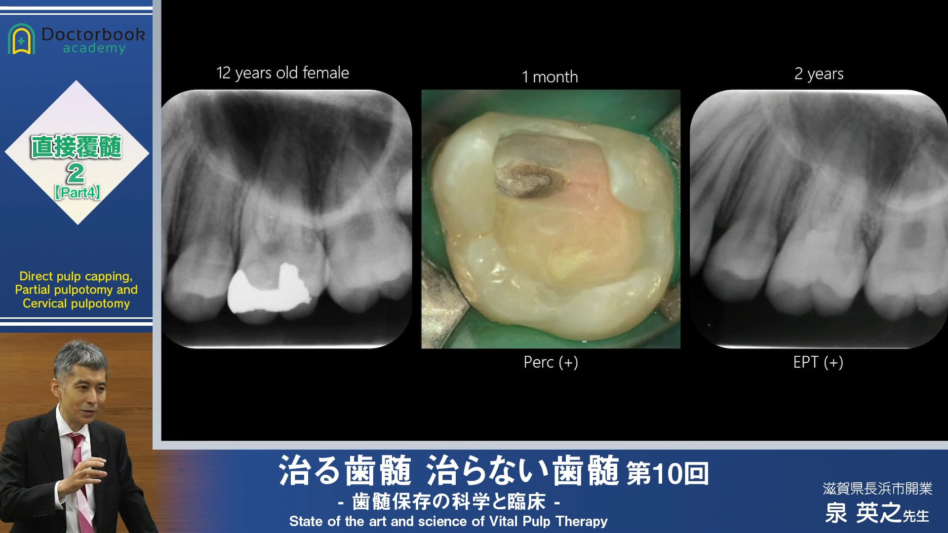 #4 部分的う蝕除去と直接覆髄、断髄はどちらが良いのか？