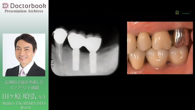 長期的予後を考慮したインプラント補綴