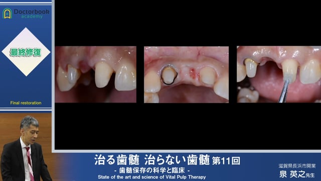 #1 歯頸部断髄をした場合の最終修復