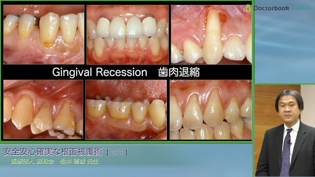 歯肉退縮の原因とリスク診断 根面被覆術に用いる材料 #1