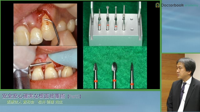 歯肉退縮の分類(Miller / Cario) フラップと歯間乳頭の切開について #2 