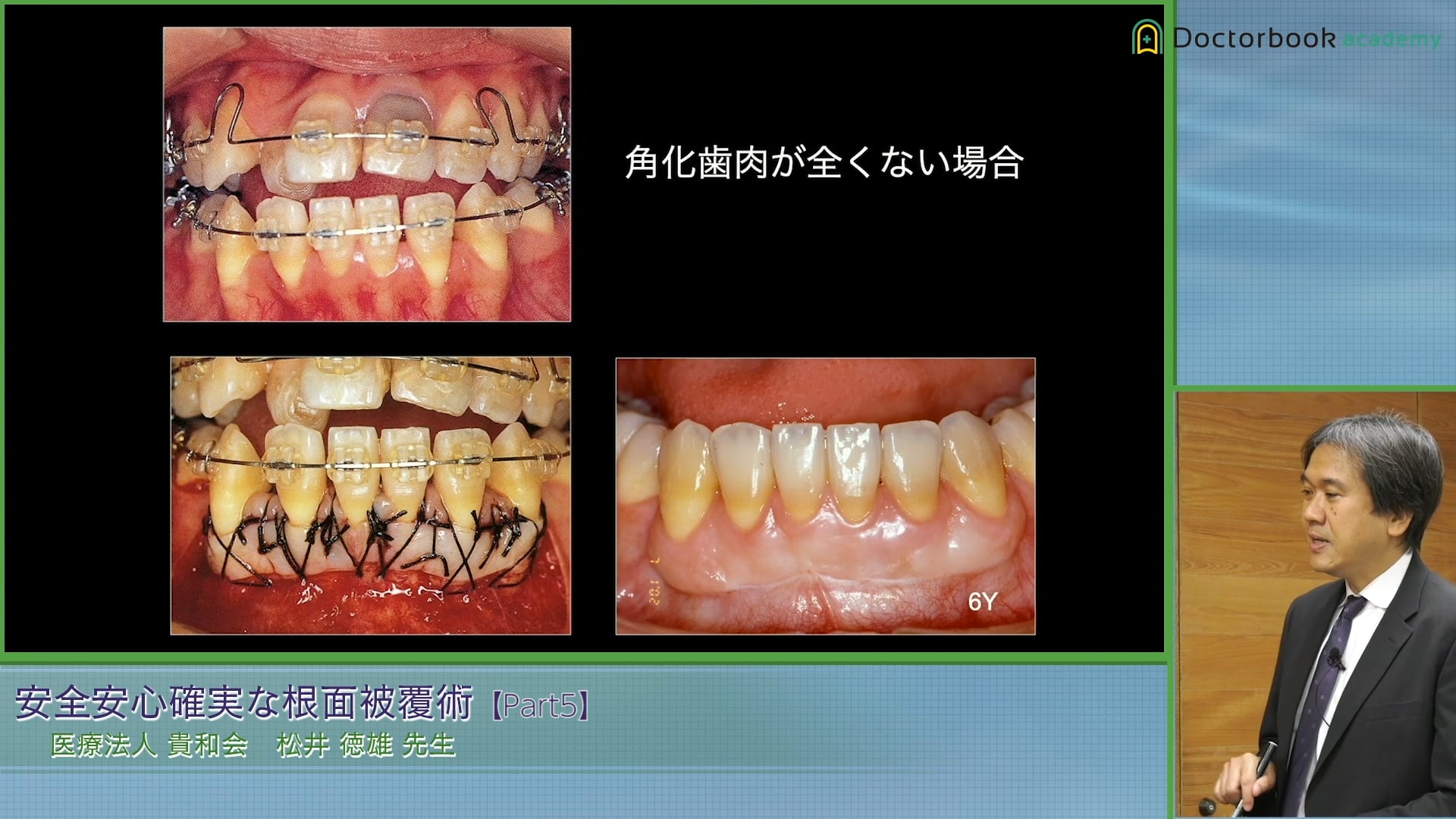 Double Pedicle graft Laterally Positioned Flapと根面被覆術式の選択基準 #5