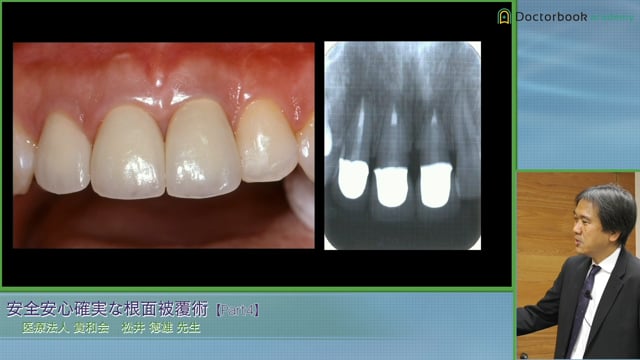 Coronally Positioned Flap / VISTA / Modified Langer Technique / Envelope Technique / MCAT #4