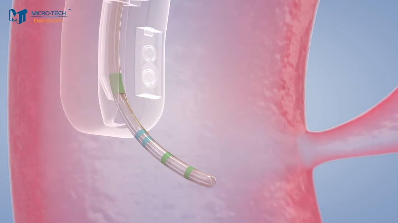 Micro-Tech ERCP on Vimeo