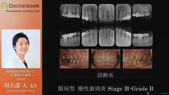 歯周病新分類を用いた症例報告と解説 | Doctorbook academy