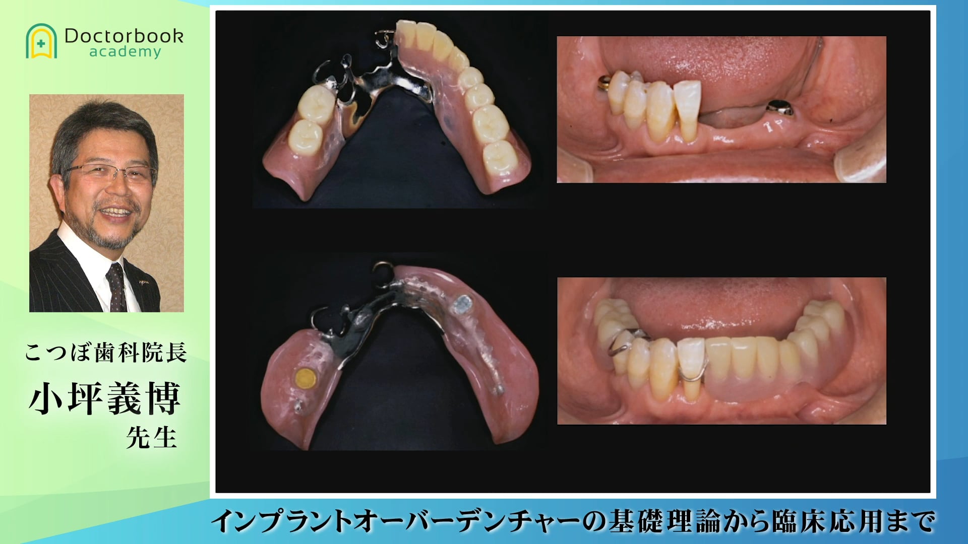 インプラントオーバーデンチャーの臨床とエビデンスQA インプラントを