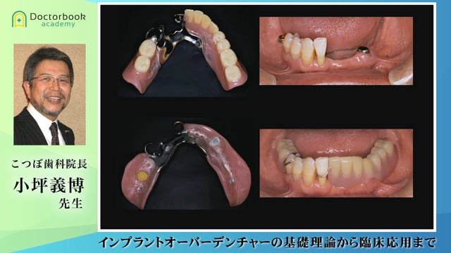 #1 吸着義歯について