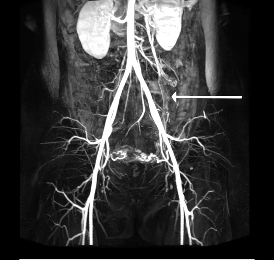 Pelvic Congestion Syndrome – Body MRI