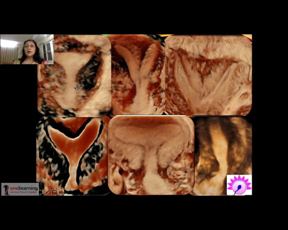 3D/4D Gynecology Ultrasound Tips & Tricks