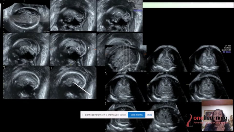 3D/4D Uterus Normal Vs Abnormal