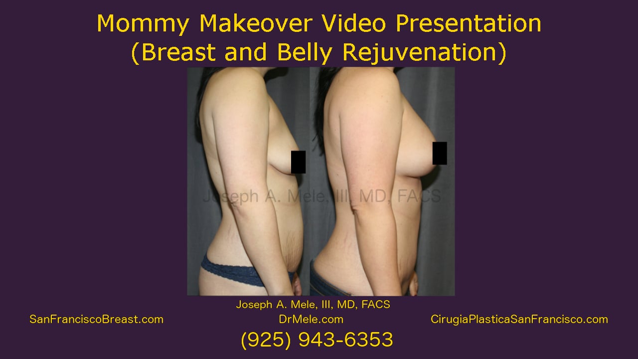 Mini Tummy Tuck Video (Mini Abdominoplasty) - SF Bay Area - 27
