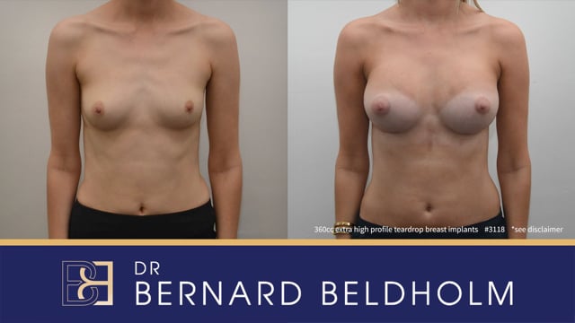 640px x 360px - Teardrop Breast Implants Before & After Result Between 300cc and 399cc