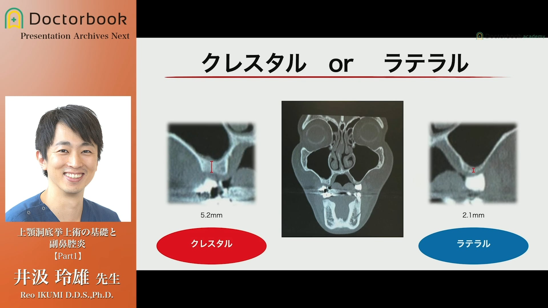 #1  クレスタルアプローチとラテラルアプローチの比較