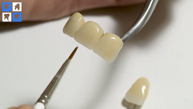Restaurare protetica in zona frontala