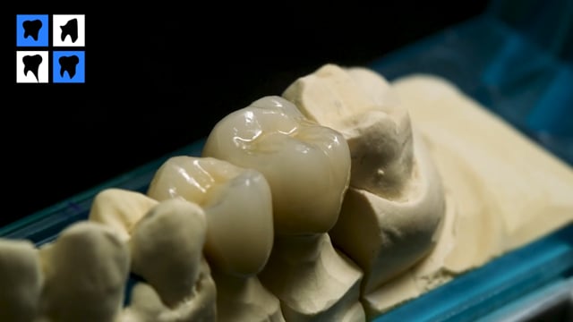 Restaurare metalo-ceramica premolar-molar cu GC Initial