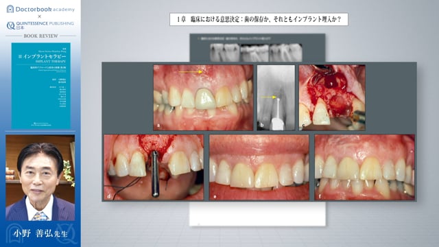 #2 重度歯周病患者に対する矯正治療とインプラント治療の効果的な適用