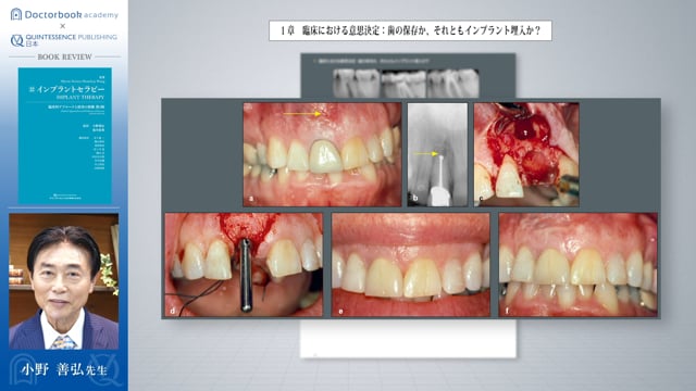 Book Rev.】増補新版 インプラントセラピー 臨床的アプローチと成功の