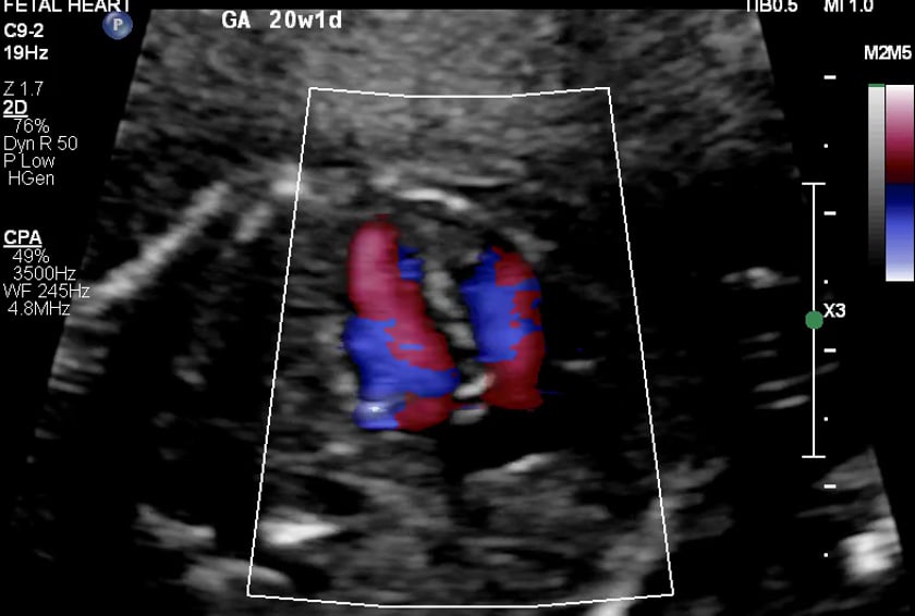 fetal lvot ultrasound