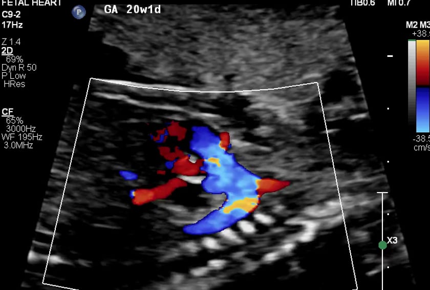 a B-mode image demonstrating a cervical length measurement