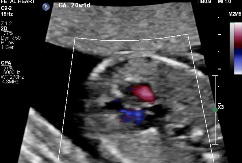 fetal lvot ultrasound