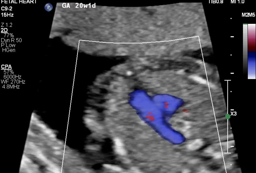 fetal heart anatomy