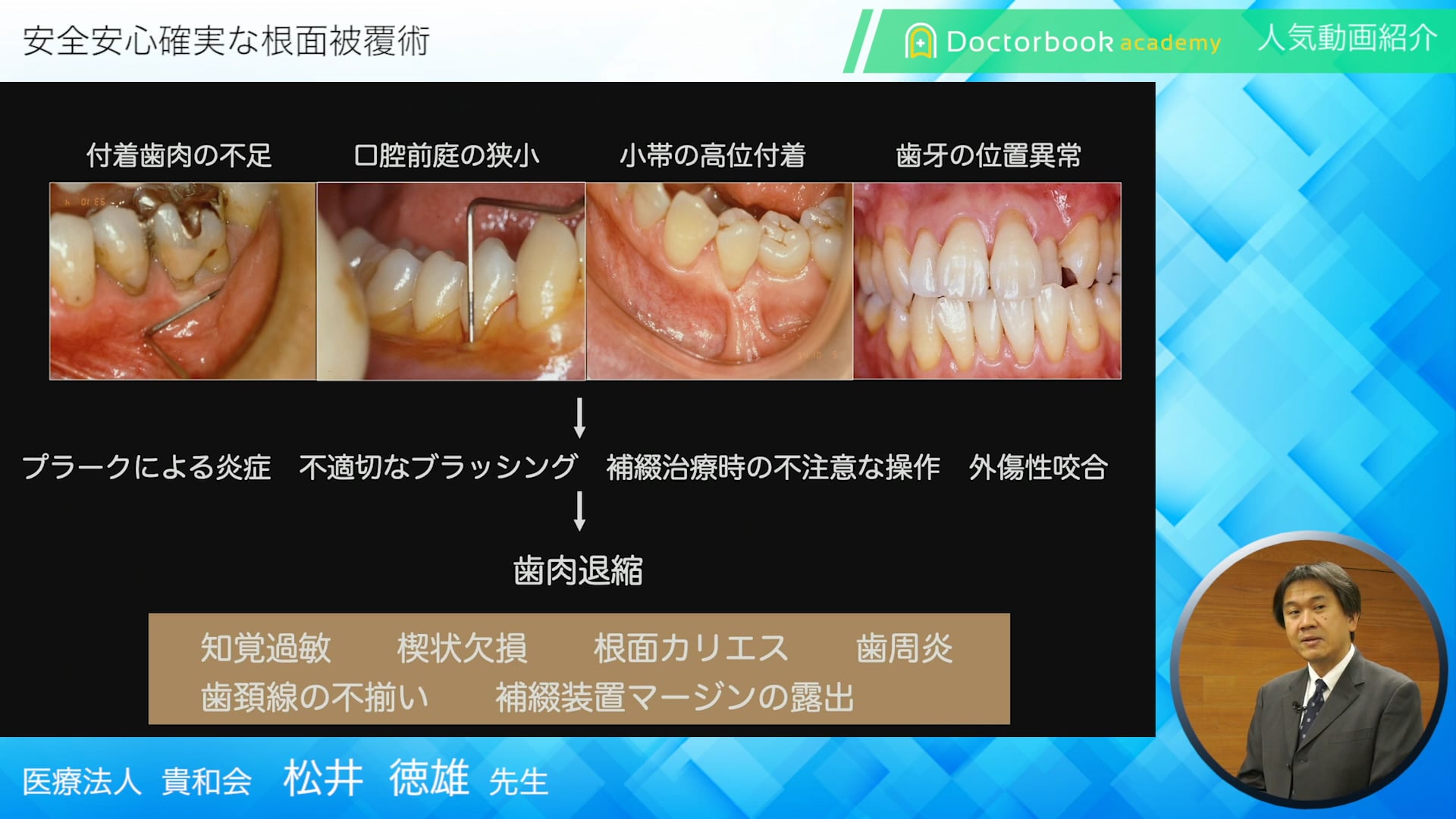 【Doctorbook academy 人気動画紹介】安全安心確実な根面被覆術